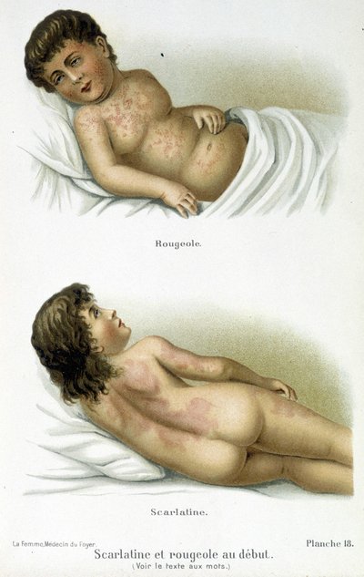 Scarlatine et rougeole - XIXe siècle - Unknown artist