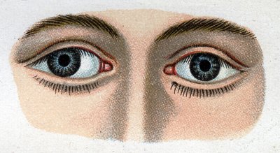 Strabisme divergent. « La nouvelle médication naturelle » de F.E. Bilz. - Unknown artist