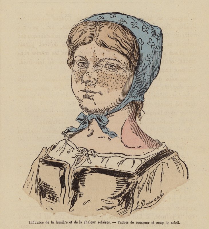 Femme avec des taches de rousseur et un coup de soleil causé par une exposition excessive au soleil - (after) French School