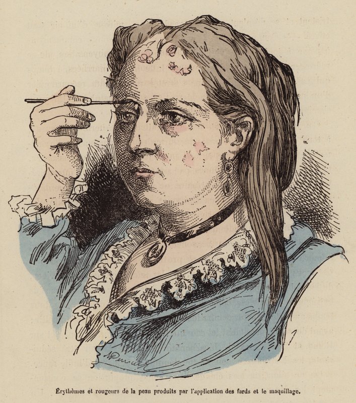 Femme avec des éruptions cutanées et des rougeurs causées par l