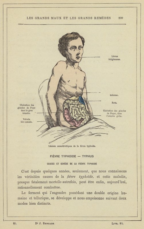 Lésions caractéristiques de la fièvre typhoïde - French School