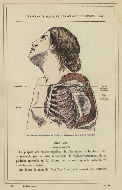 Luxation sous coracoïdienne de l