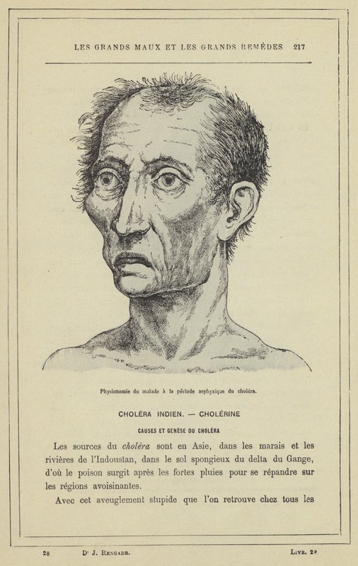 Physionomie du malade à la période asphyxique du choléra - French School