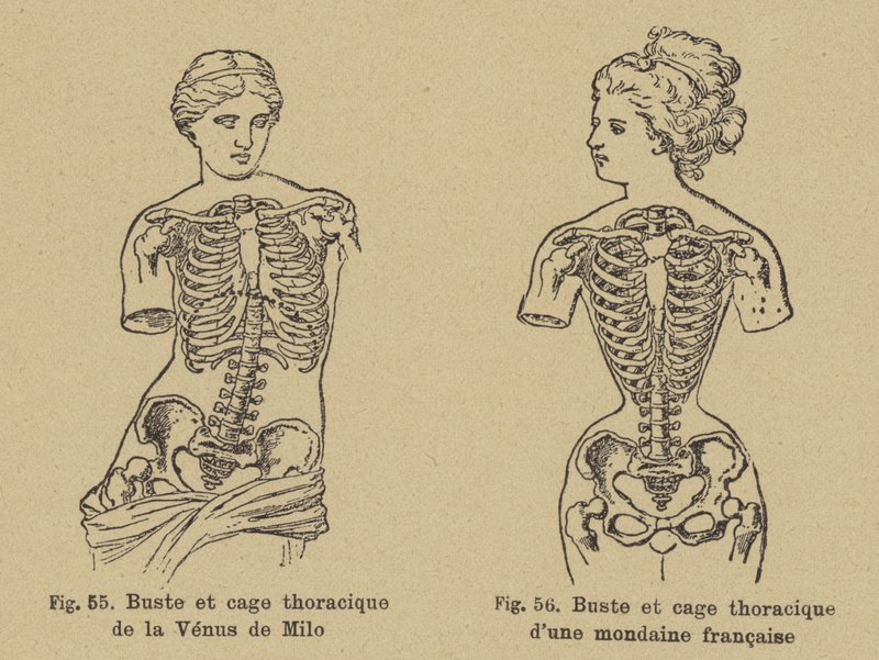 Comparaison de la forme de la poitrine et de la cage thoracique de la Vénus de Milo avec celle d
