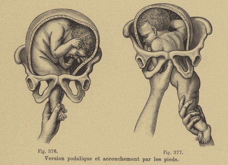 Accouchement d