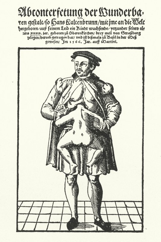 Hans Kaltenbrunn et son jumeau conjoint non développé - German School