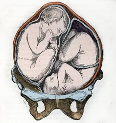 Représentation de la bonne position de deux fœtus lors d