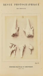 Exostoses multiples et symétriques, fémur, tibia