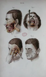Planche anatomique de la mâchoire supérieure