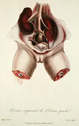 Hernie inguinale de l
