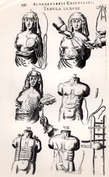 Opération sur un cancer du sein, de Armamentarii Chirurgici par Johannes Schultes (1595-1645) publié à Amsterdam, 1672