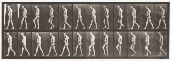 Planche 555. Atrophie musculaire des jambes; adulte, A,B, marche, 1885
