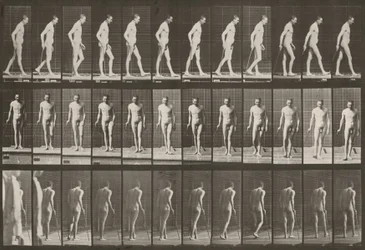 Planche numéro 559. Paraplégie partielle, marche avec une canne