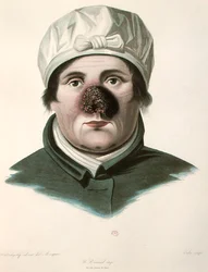 Avant une opération de greffe de peau, de 