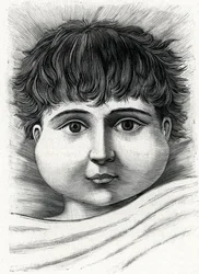 Enfant avec la maladie des oreillons (gravure) 1888