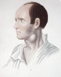 Patient avec un anévrisme, de 