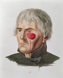 Maladie de la peau avant une opération, tiré de Selecta Praxis Medico-Chirurgica par Alexander Auvert, Paris, 1856