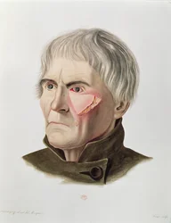 Opération de greffe de peau, tiré de Selecta Praxis Medico-Chirurgica par Alexander Auvert, Paris, 1856