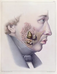 Les symptômes faciaux de la maladie vénérienne, de Traité Complet des Maladies Vénériennes par Philippe Ricord, 1851