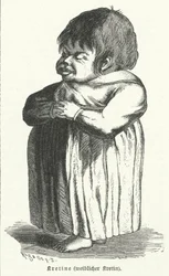 Crétin, femme souffrant de carence congénitale en iode (gravure)