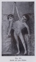 Giacomo et Giovanni Battista Tocci, jumeaux siamois italiens