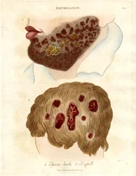 Illustration pathologique du sycosis barbae et du sycosis capilli