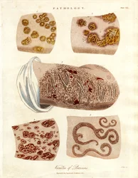Modifications pathologiques de la peau : Variétés de psoriasis