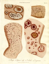 Affections cutanées pathologiques : Schurigie ; peau lépreuse ; pallada et impétigo