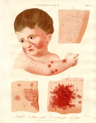 Maladies pathologiques de la peau