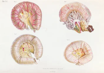 Surface externe des intestins infectés par le choléra, de Anatomie Pathologique du Cholera Morbus, par Nikolai Ivanovich Pirogov, publié à Saint-Pétersbourg, 1849
