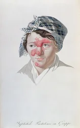Pustules syphilitiques en grappe, d