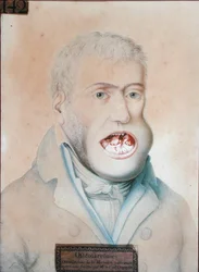 Ostéosarcome de la mâchoire inférieure, opéré avec succès par Guillaume Dupuytren (1777-1835)