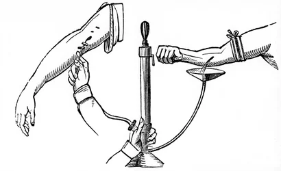Transfusion sanguine de personne à personne, 1833