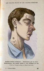 Symptômes de la phase tertiaire de la syphilis, XIXe siècle