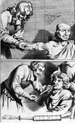 Saignée et douche nasale par Johannes Sculpteti Armamentarium Chirurgicum Amsterdam 1672