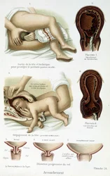 Accouchement - planche scientifique, fin XIXe siècle