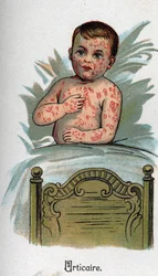 Maladies infantiles : Urticaire. dans « La nouvelle médecine naturelle » par F.E. Bilz