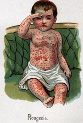 Maladies infantiles : Rougeole. Dans « La nouvelle médecine naturelle » par F.E. Bilz.