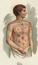 Maladies infantiles : La gale. Dans « La nouvelle médication naturelle » de F.E. Bilz