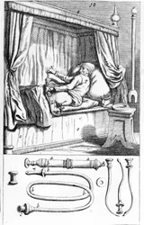 Clystère (pour lavements) par Johannes Sculptetus « Armamentarium Chirurgicum ». Venise 1665.