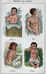 Maladies des enfants : Urticaire, Rougeole, gale, scarlatine. Dans "La nouvelle médication naturelle" de F.E. Bilz