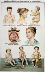 Planche illustrant les différentes formes de maladies syphilitiques et les dangers de la vaccination - dans la médecine naturelle de Bilz, fin du XIXe siècle.